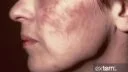 آکنه روزاسه صورت