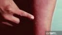 درماتیت یا اگزما آتوپیک