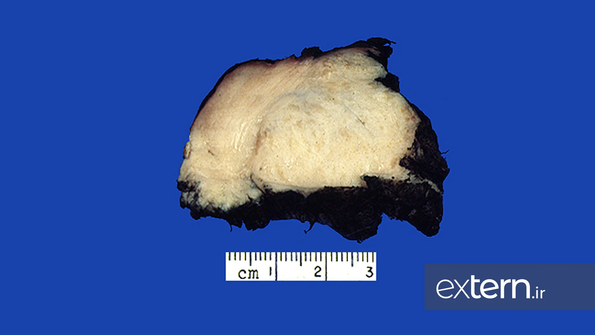 فیبروز غده تیروئيد در تیروئيدیت ریدل در نمای گروس